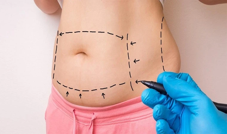 Liposuction Nedir? Yöntemleri Nelerdir? Görseli