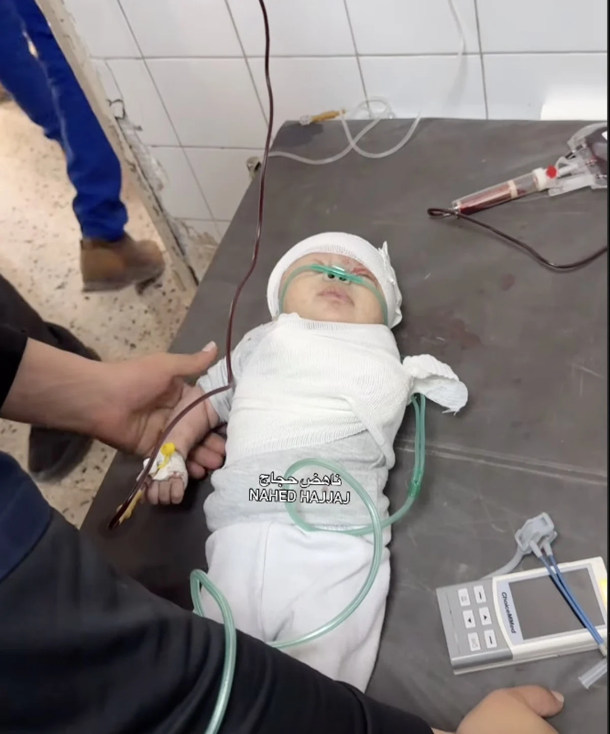 Gazze’de Minik Bir Bebeğin Dramı: İsrail Saldırısında Kolu Koptu Görseli